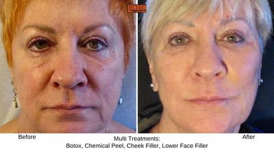 
Cheek filler,lip filler,facial sculpting, injectable, tear trough filler, nasolabial fold, marionette lines, wrinkles, chemical peel