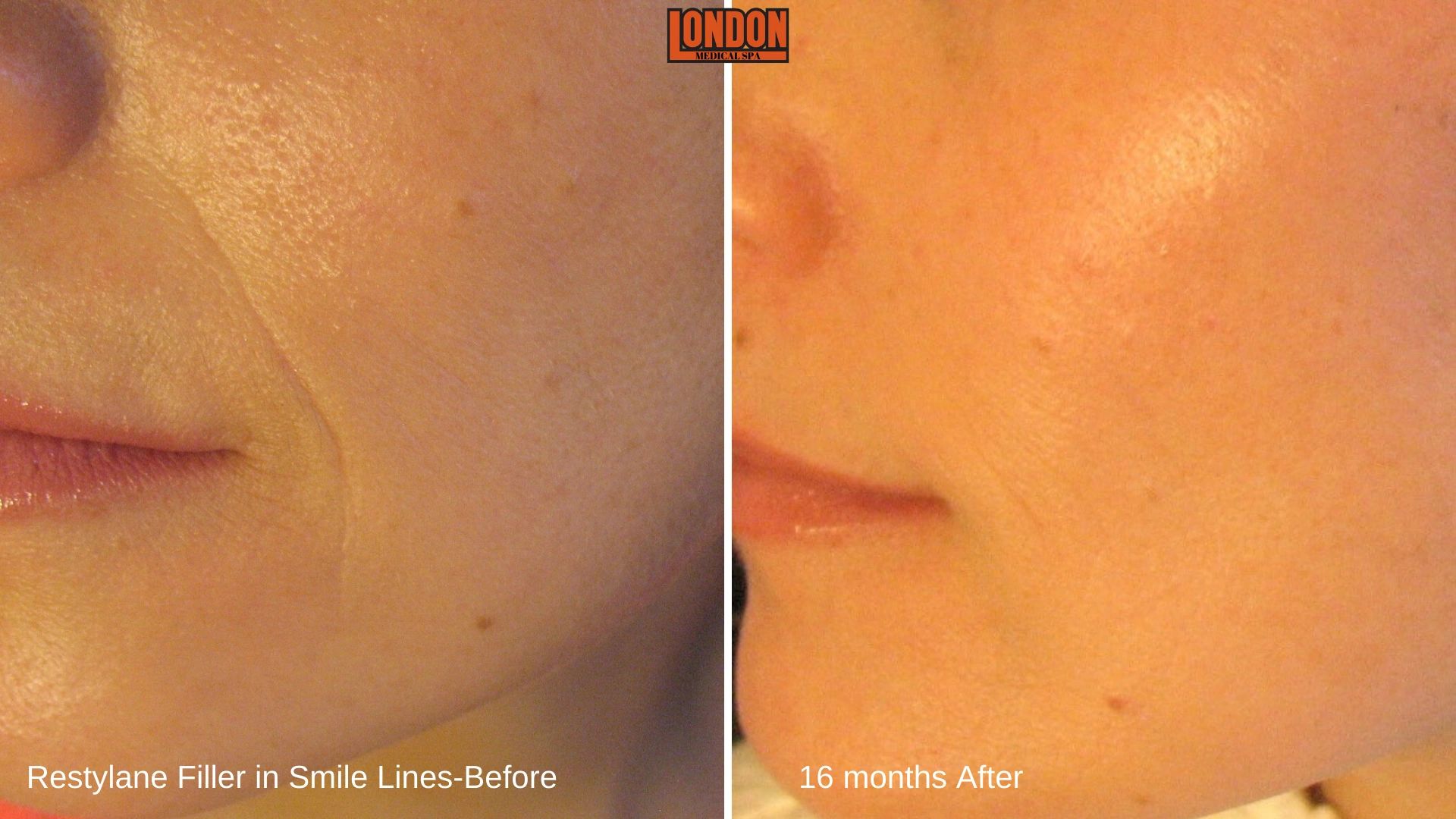 Restylane Filler in smile lines