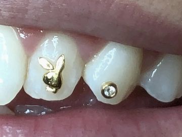 Tooth Gems / Gold Charms