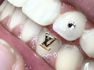 18k Gold Tooth Gems LV - Dentluxe