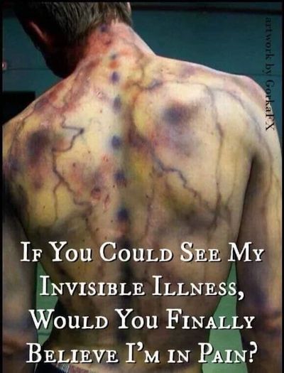 If you could see my chronic pain.