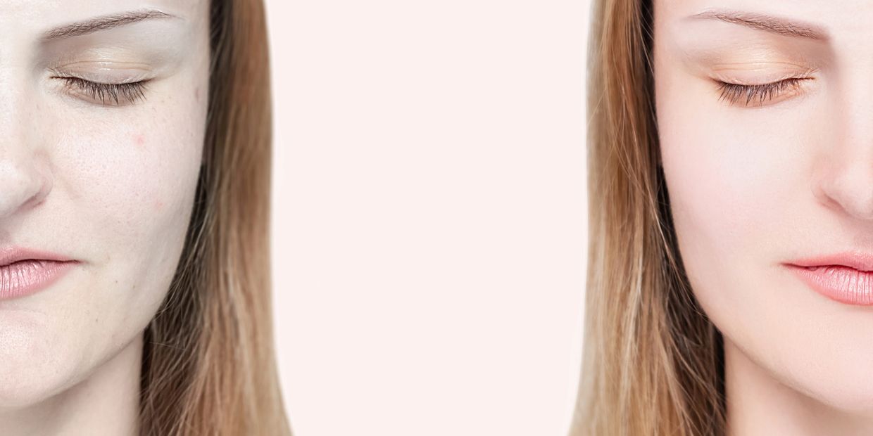 A young woman shows her before and after pics following a  BB Glow treatment.
