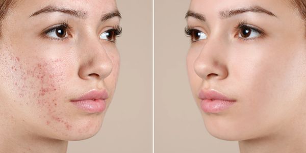 A young woman shows her before and after pics following a Micro-Needling Facial