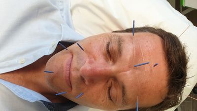 Cosmetic acupuncture for men
FacialEnhance