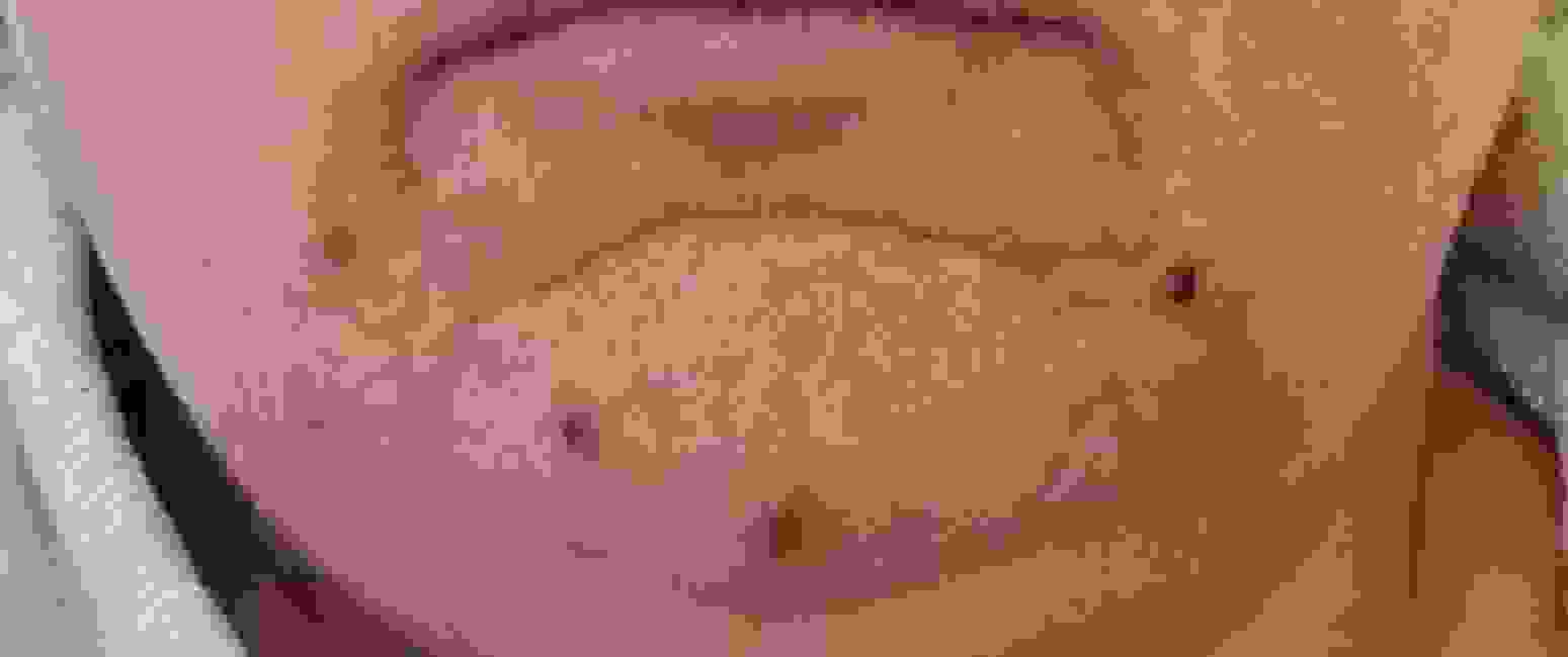 Acne Skin Treatment Dr Justin Lim Dr Selina Lim Professor Yoland Lim Health Care Laser JUVEFACE skin