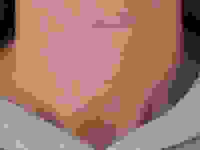 Treatment Dr Justin Lim Dr Selina Lim Professor Yoland Lim Health Care Laser JUVEFACE skin neck pain