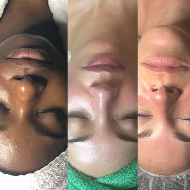 exfoliating, extractions facial