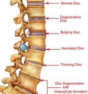 Illustration of disc problems in the spine