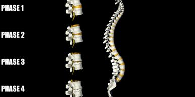 Phases of joint degeneration in the spine
