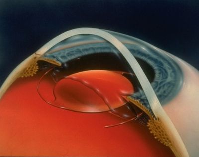 cataract surgery