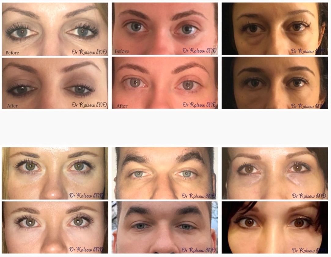 Before and after photos of under eye (tear trough) filler. 