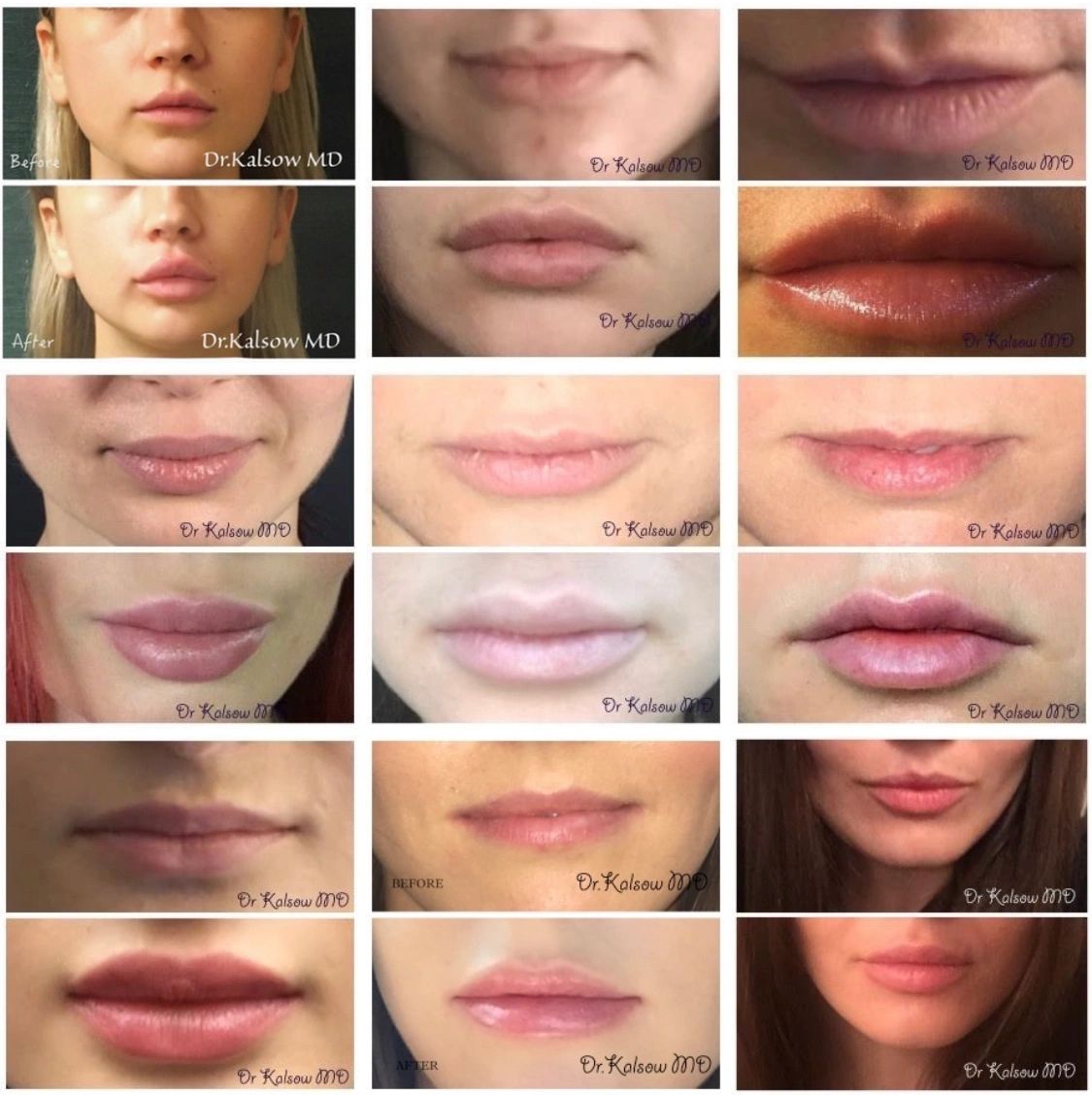 Before and after photos of lip augmentation.  