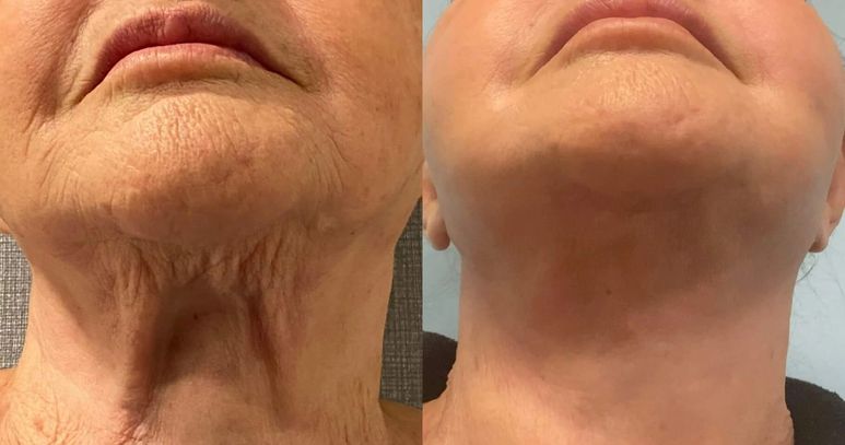 Dr.Kalsow facelift specialist, before and after, facelift/necklift.  