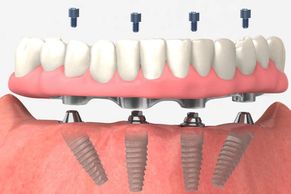 Dental Implant Specialist, Affordable Dental Implant, Dental Specialist, Dental Implant, LADD Dental