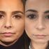 Before & After Microneedling