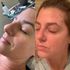 Before & After TCA Peel
