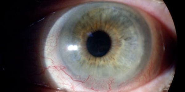 Picture of Eye