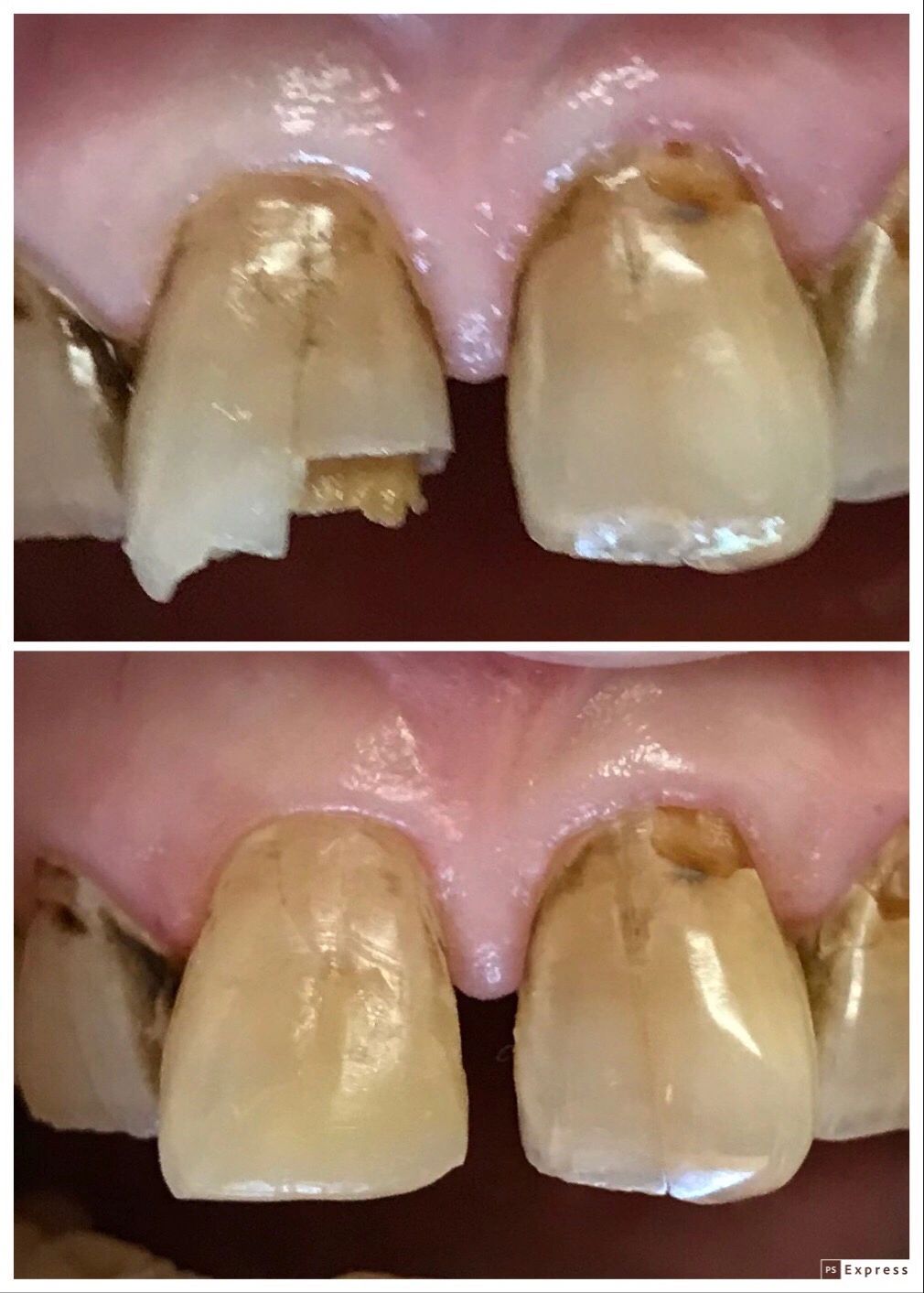 BEFORE AND AFTER COSMETIC BONDING UPPER FRONT TOOTH