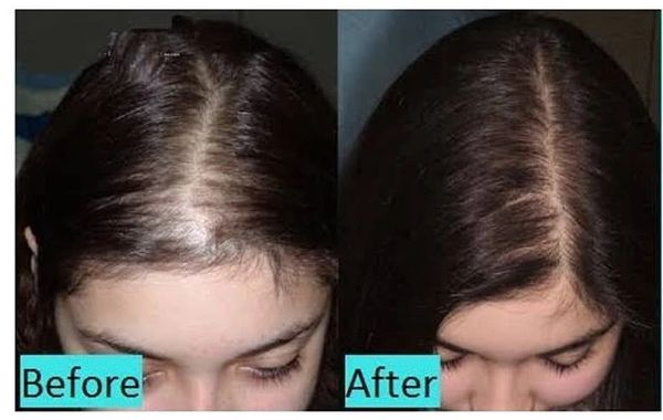 #hairloss #hairgrowth #newhairgrowth #balding #microneedlinghairgrowth #skinrepair #microneedlinggta