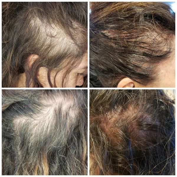 #hairgrowth #stimulatehair #thickhair #newhair #balding #microneedling #prpgta #hairrepair