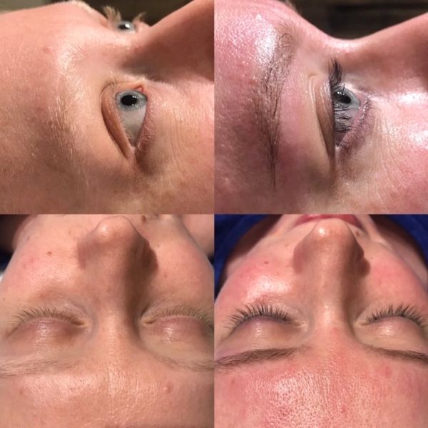 Meraki Esthetics Olympia Spa Before and After Microneedling