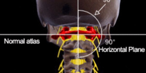 Spinal-Cord Stimulators - Even Worse Than Opioids?