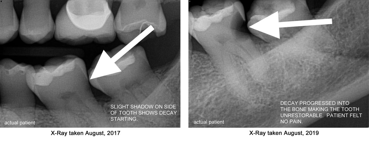 This patient was told he needed a small filling in 2017, but he waited.