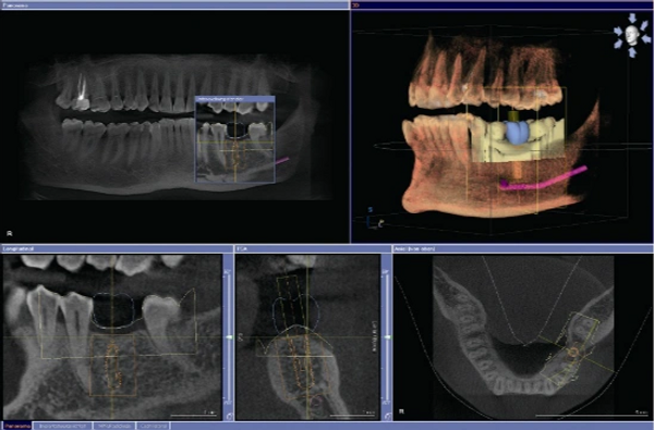 3D scan is used to plan out your new dental implant.
