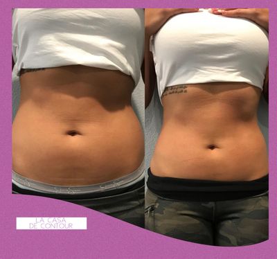 Ultrasonic Cavitation at Home  Before and After (With Photos)