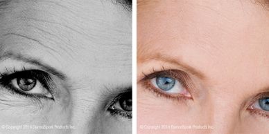 2 pictures of a woman's forehead showing the before and after effects of micro-needling.