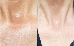 before and after neck rejuvenation photo