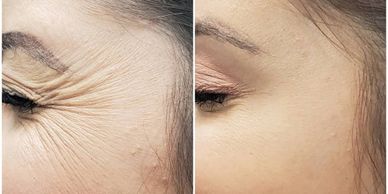 Lake Country Aesthetics - Before and After Photos Botulinum Toxin Botox