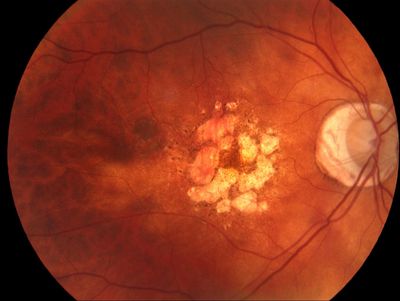 Dry  amd showing  geographic atrophy and scarring without bleeding.  