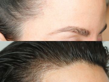 tattoo scalp tattooed hair line hair restoration tattooing tattoo hair replacement