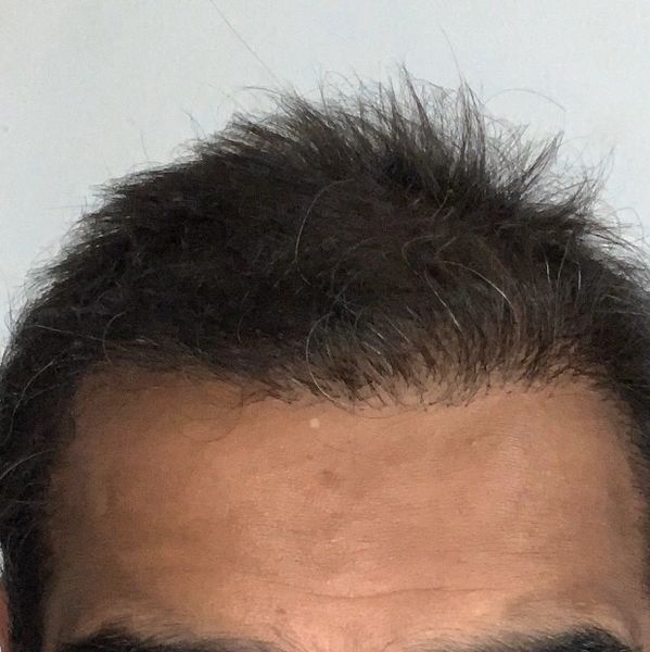 Neograft Hair Transplant Neograft Hair Transplant