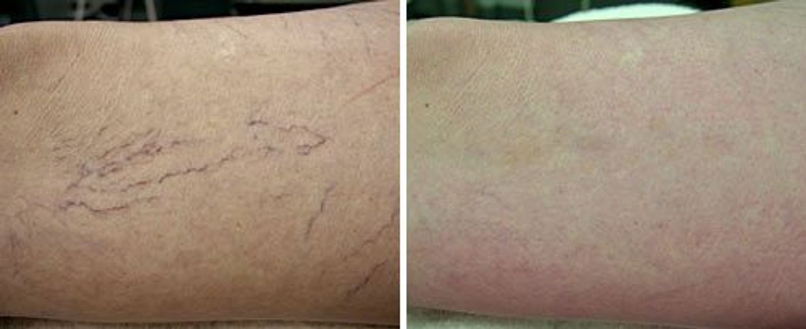 Spider Vein Removal OMNI surgery Regina
