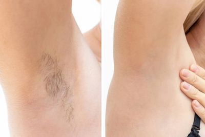 Laser Hair Removal - Before and After Pictures