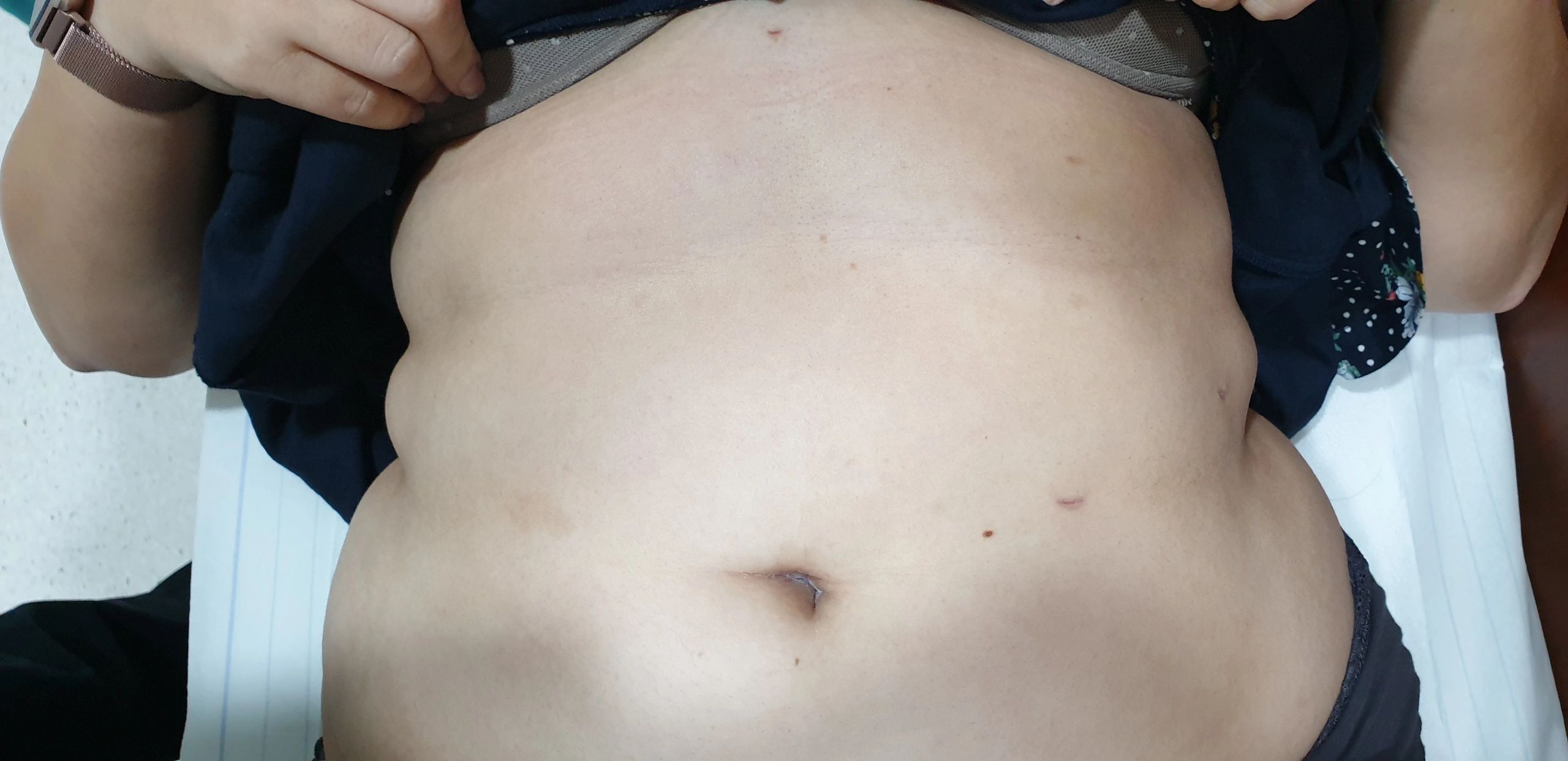 INVISIBLE (HIDDEN) SCAR BARIATRIC SURGERY.