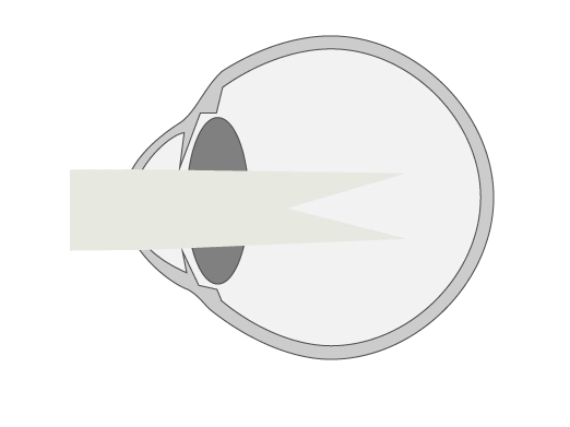 incorrect projection of light rays in the eyes due to astigmatism