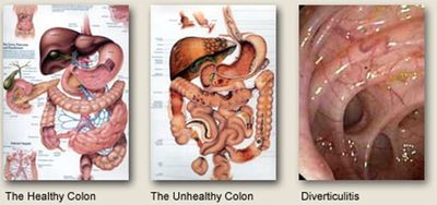 colon hydrotherapy waste