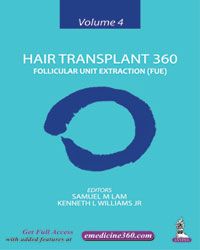 Hair Transplant 360 Follicular Unit Extraction (FUE), Volume 4 | A ...