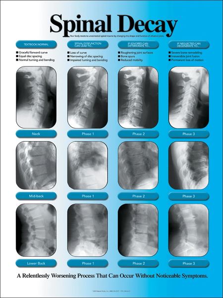 Spinal Decay Poster
