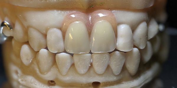 Partial Dentures