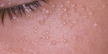 grano di miglio punti bianchi sotto pelle millet grain white spots under the skin