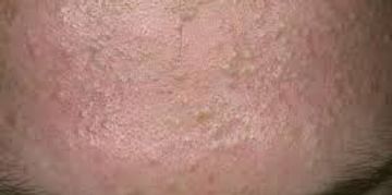 punti neri sotto pelle impurita sotto pelle blackheads under skin impurities under skin