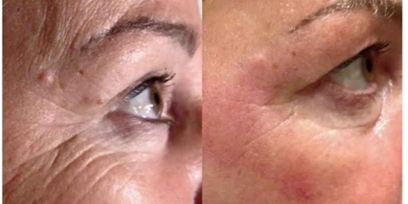 Frotox using cool sculpting and cryo beauty enhancements.