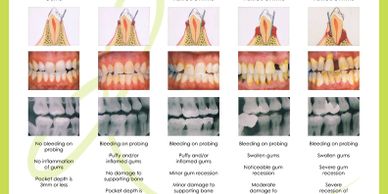 Gum (periodontal disease)