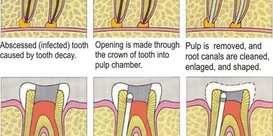 Root Canal