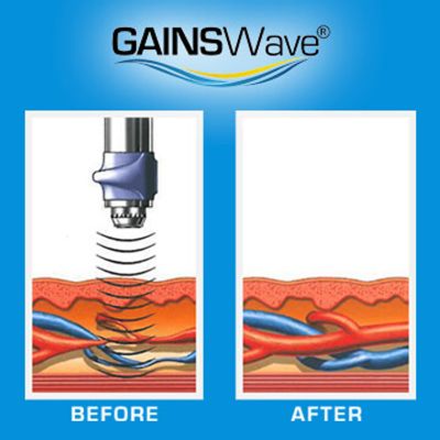 How much does GAINSWave therapy work?