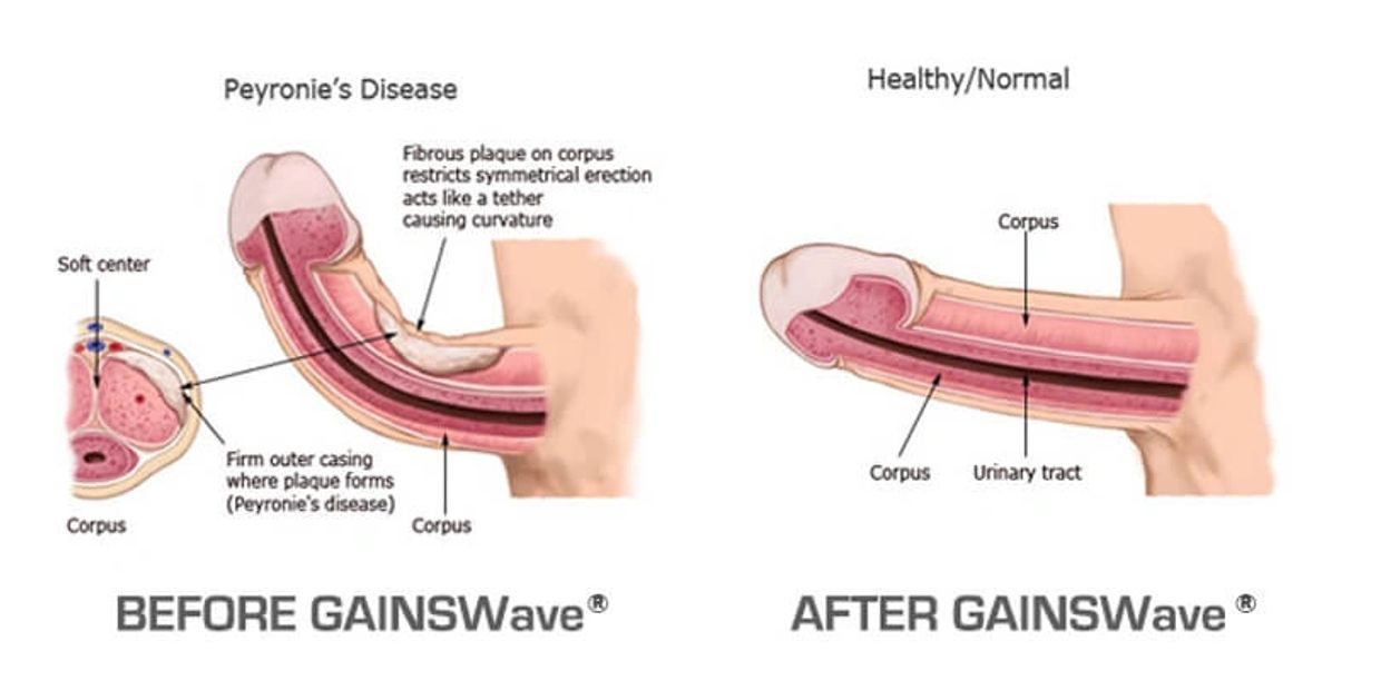 GAINSWave shock wave therapy for Peyronie's disease